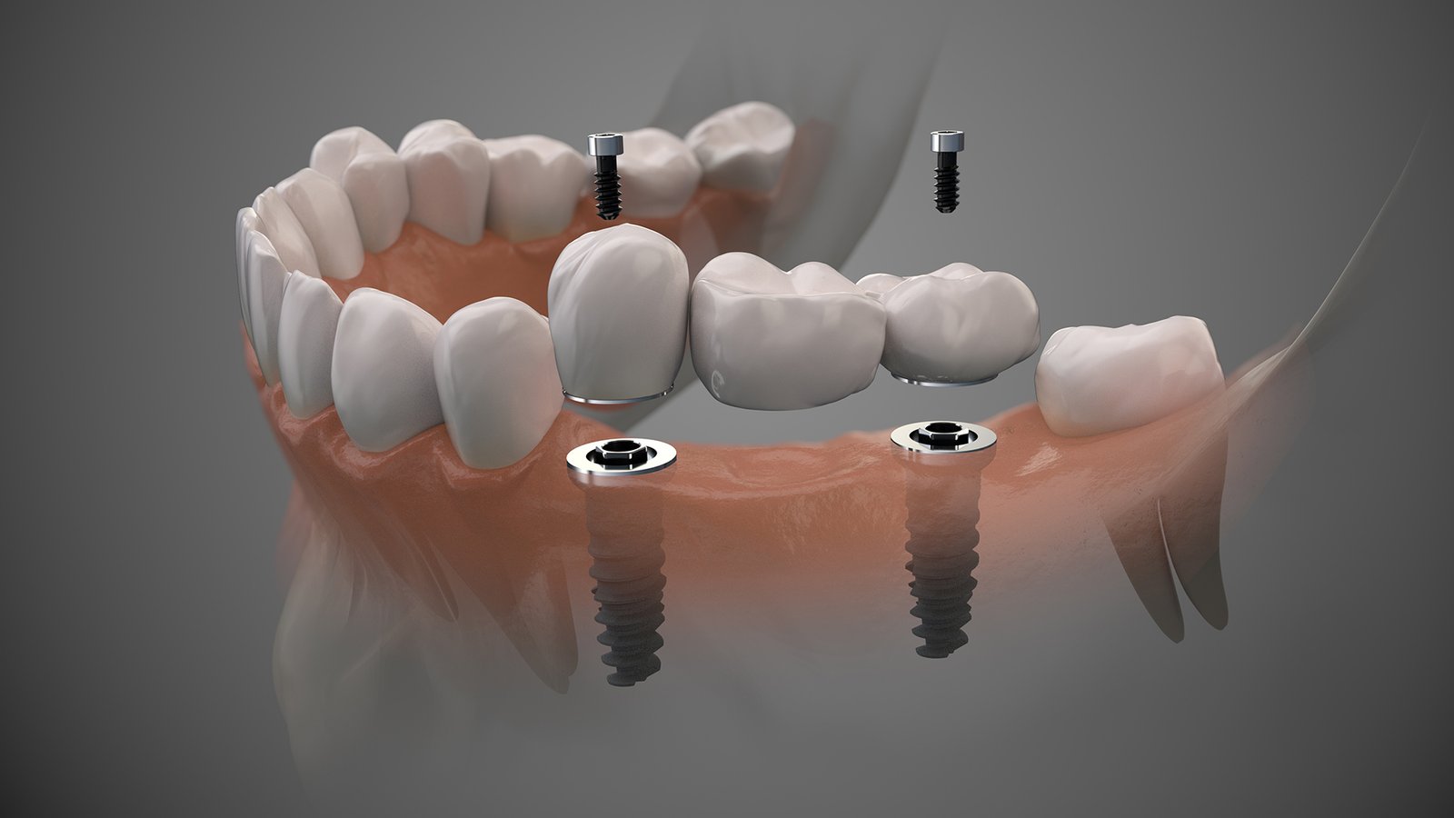 Fog implantátum árak és foggyökér eltávolítás